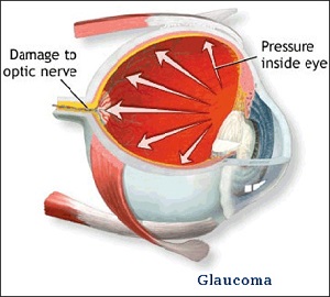 best eye surgen